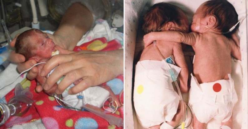Dos gemelos: uno sano y otro moribundo, sobreviven gracias a una enfermera  - Un Millon de Ideas